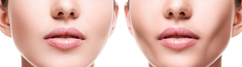 Articulo sobre la bichectomía