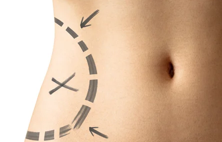 Articulo sobre lipoescultura.