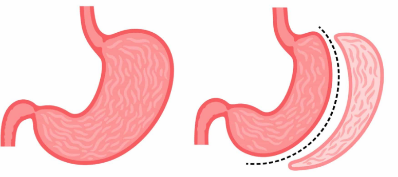 Articulo sobre la manga gástrica